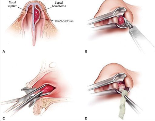 睪丸炎微創(chuàng)手術(shù)的優(yōu)勢(shì)